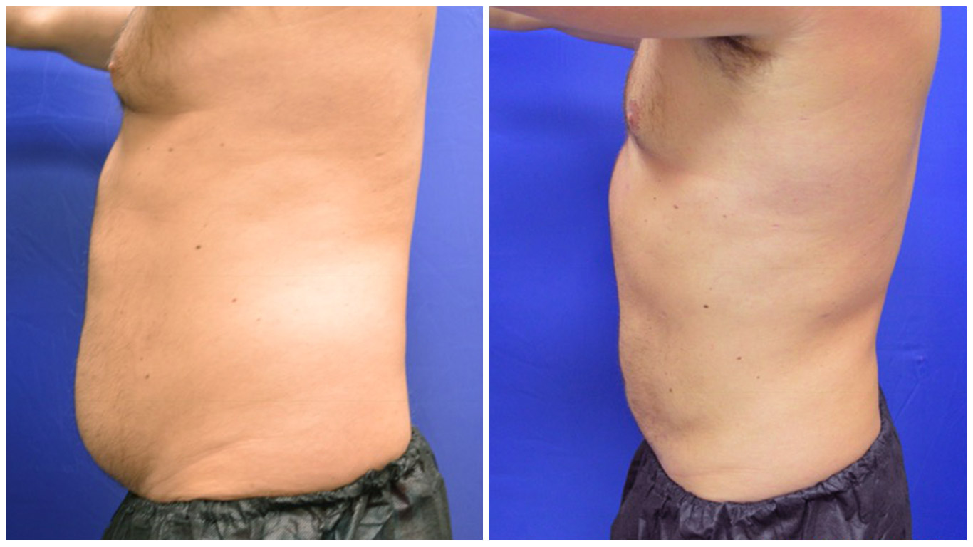 lipo04