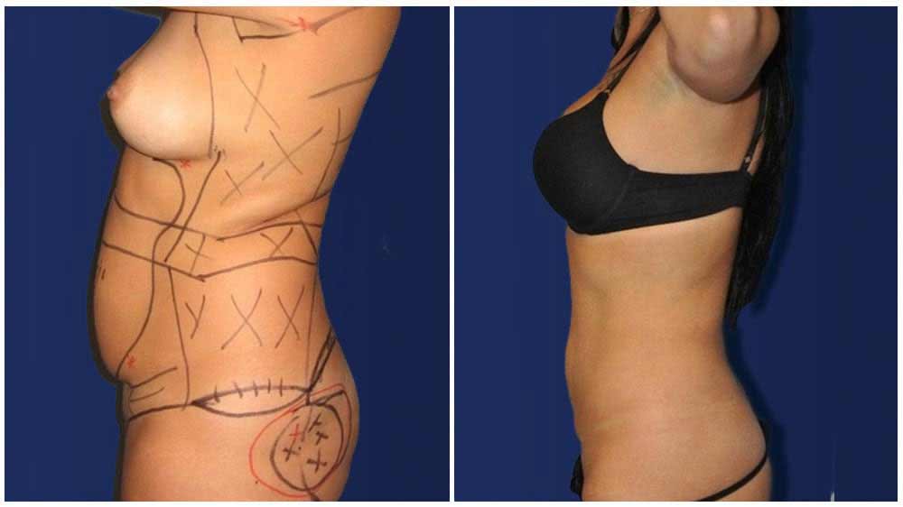 Fat Transfer of a Kansas City Liposuction Specialty Clinic Female Patient - (30 years)