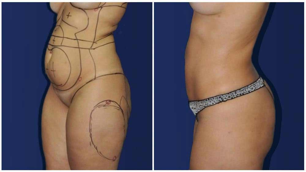 Lipo360 Female Patient (34 years)